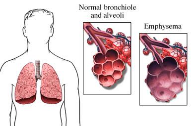 Normal vs. Emphysemic Lung