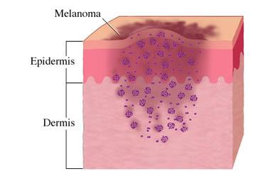 Melanoma