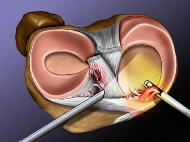 Arthroscopic Meniscectomy