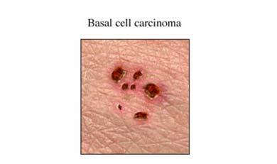 Basal Cell Carcinoma