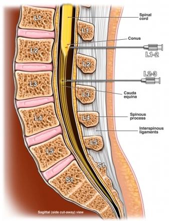 Lumbar Myelogram Injection