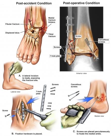 Open Reduction and Internal Fixation Surgery of the Ankle