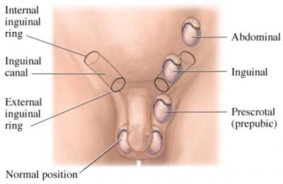 Undescended testes