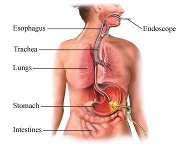 Percutaneous Endoscopic Gastrostomy Procedure