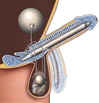 Penile Implant