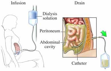 Peritoneal Dialysis