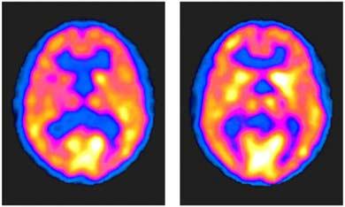 PET Scans of the Brain