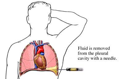 Placement of Thoracentesis Needle