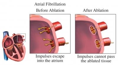 Radiofrequency Ablation Results