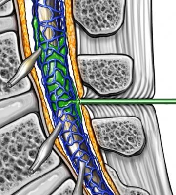 Anesthesia Injection into Spinal Canal—Epidural