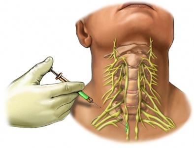 Cervical Nerve Block