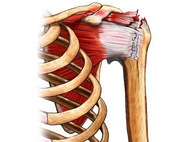 Rotator Cuff Tear