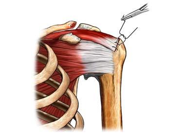 Repair of Tendons in the Left Shoulder