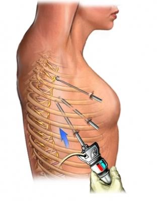 Thoracic Surgery