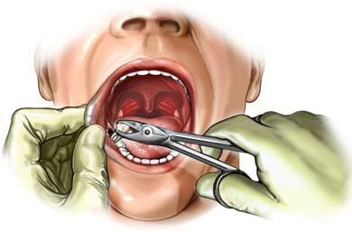 Surgical Removal of a Tooth