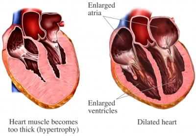 Abnormal Heart Walls