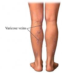 Varicose Veins