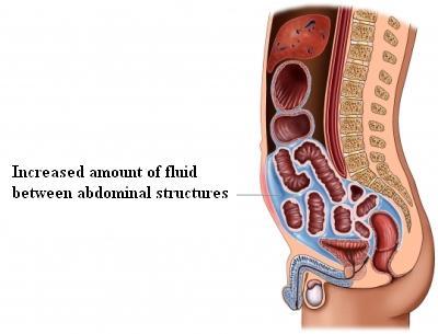 Ascites