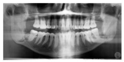 X-ray of Teeth
