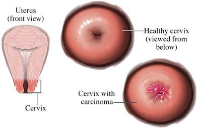 Squamous Cell Carcinoma of the Cervix
