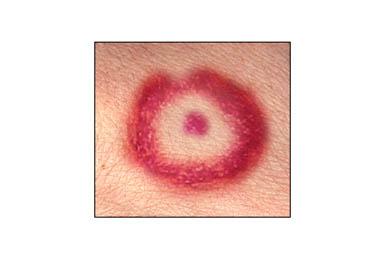 Lyme Disease Rash