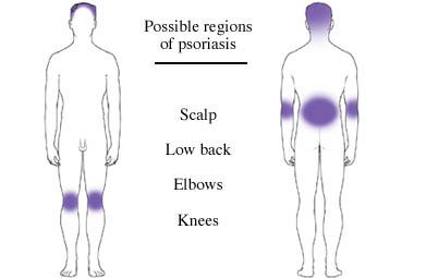 Possible Regions of Psoriasis