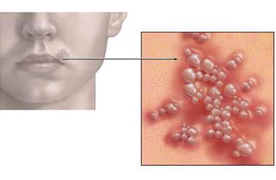 Herpes Simplex on the Lips