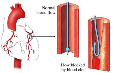 Blood Clots in the Heart