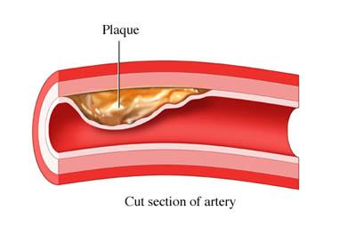 Plaque Due to Build-up of Lipids in an Artery