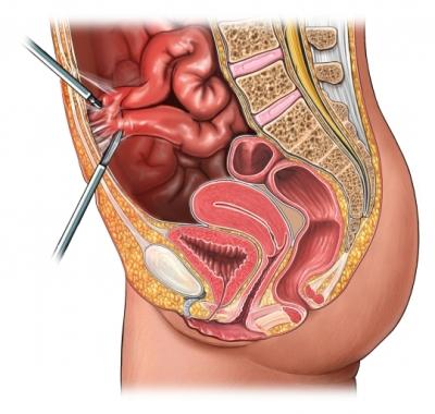 Laparoscopic Cutting of Bowel Adhesions