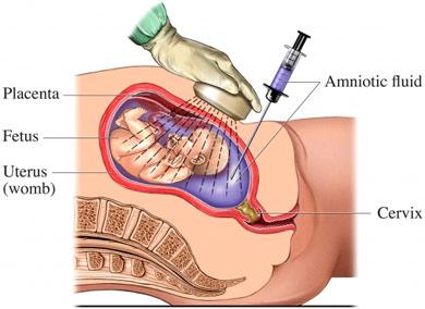 Amniocentesis