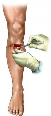 Below-the-Knee Amputation