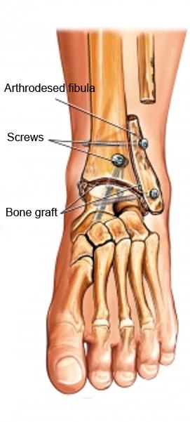 Arthrodesis of Foot and Ankle