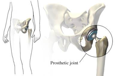 Left Total Hip Replacement