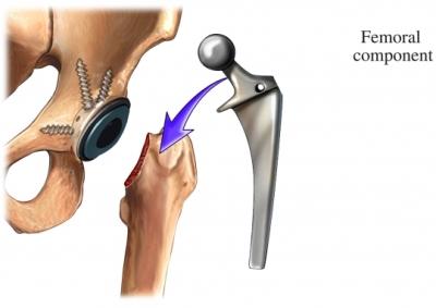 Placement of Prosthesis