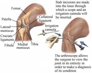 Diagnostic Arthroscopy of the Right Knee