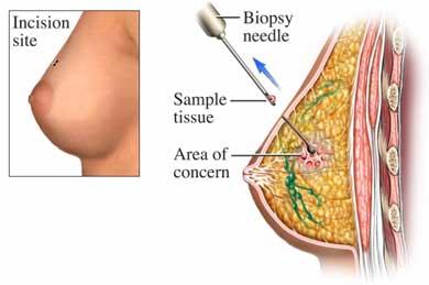 Needle Aspiration