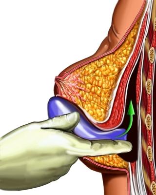 Side View of Breast Implantation