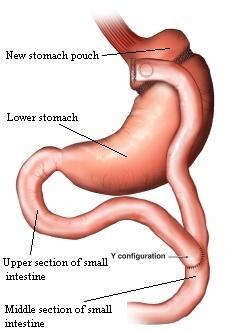 Roux-en-Y Gastric Bypass