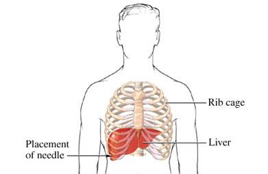 Placement of Liver Biopsy Needle