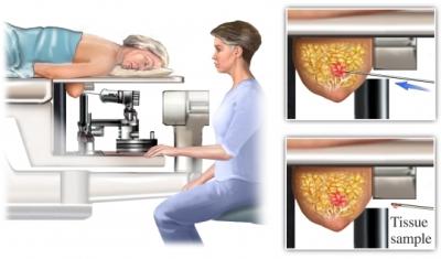 Stereotactic Biopsy