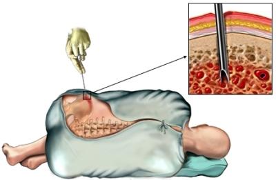 Bone Marrow Biopsy