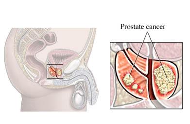 Prostate Cancer