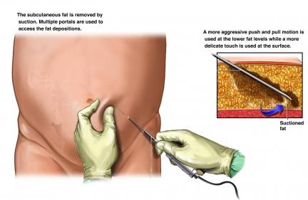 Liposuction of the Abdomen