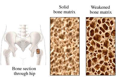 Osteoporosis