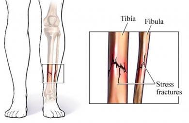 Stress Fractures