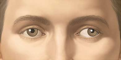 Strabismus